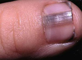 指甲尖有缺痕