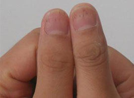 指甲有红色或黑色斑点