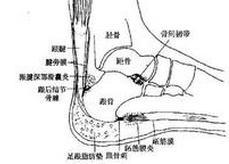 跖部纤维痛